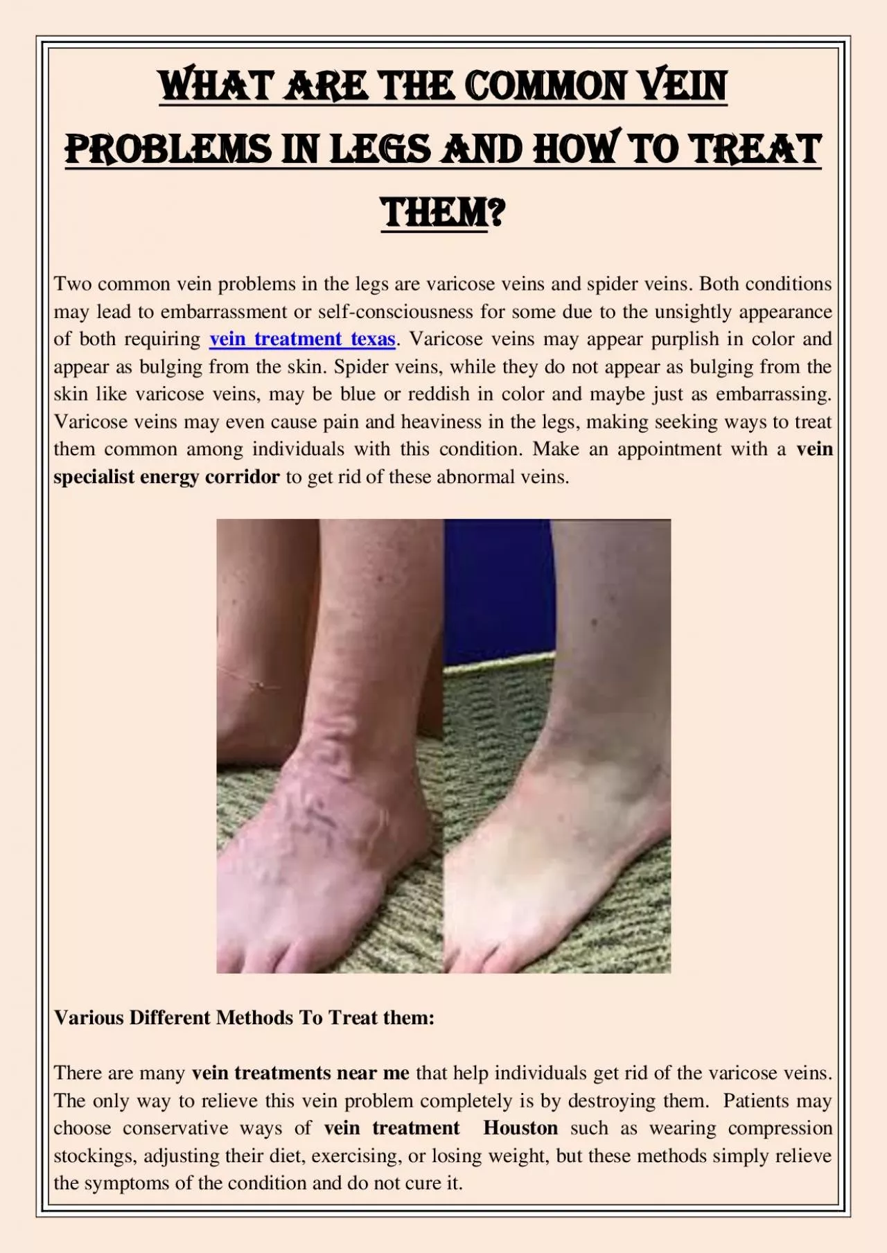 PDF-What Are The Common Vein Problems in Legs and How to Treat Them?