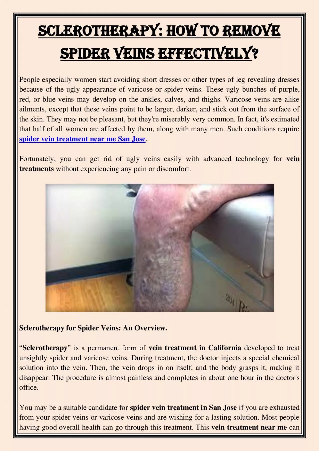 PDF-Sclerotherapy: How To Remove Spider Veins Effectively?