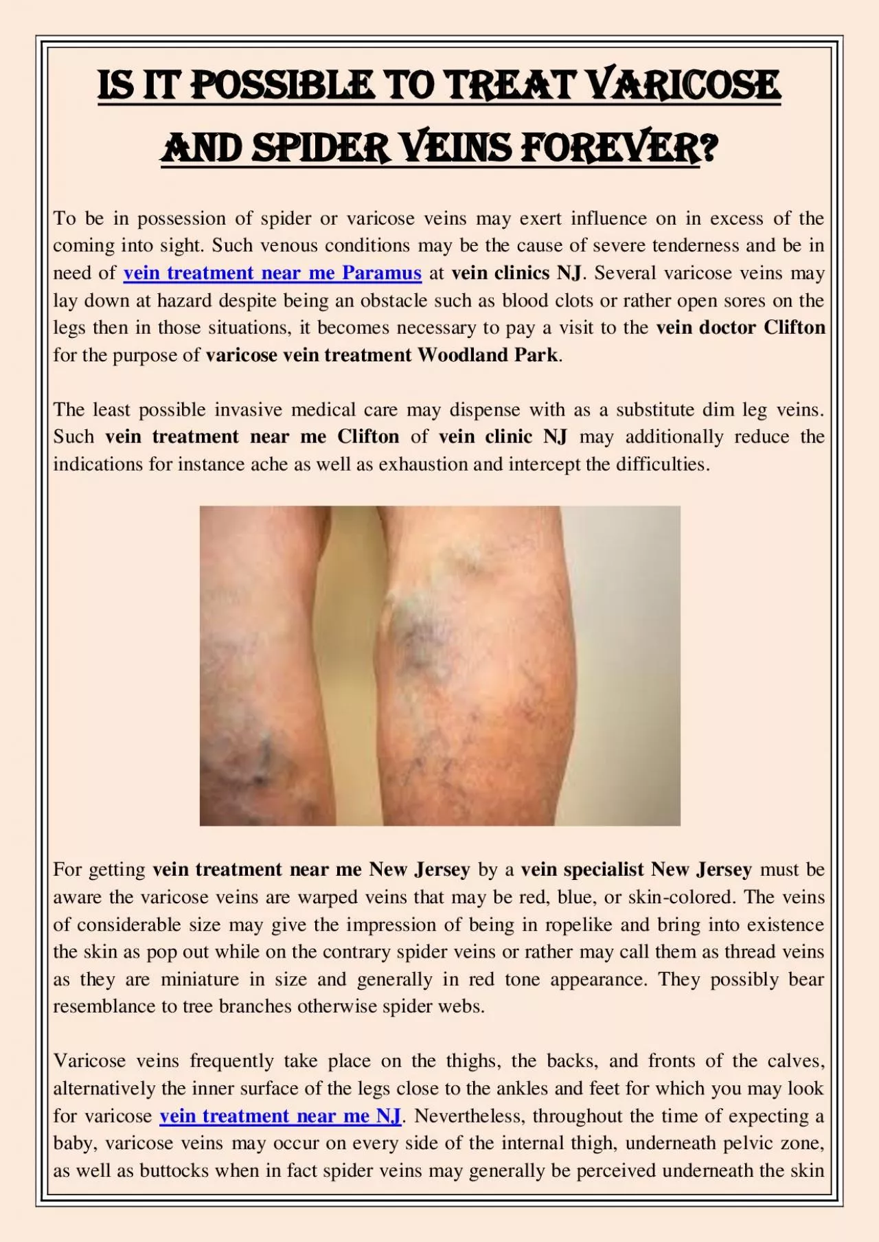 PDF-Is It Possible To Treat Varicose and Spider Veins Forever?