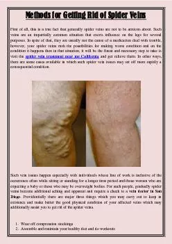 Methods for Getting Rid of Spider Veins
