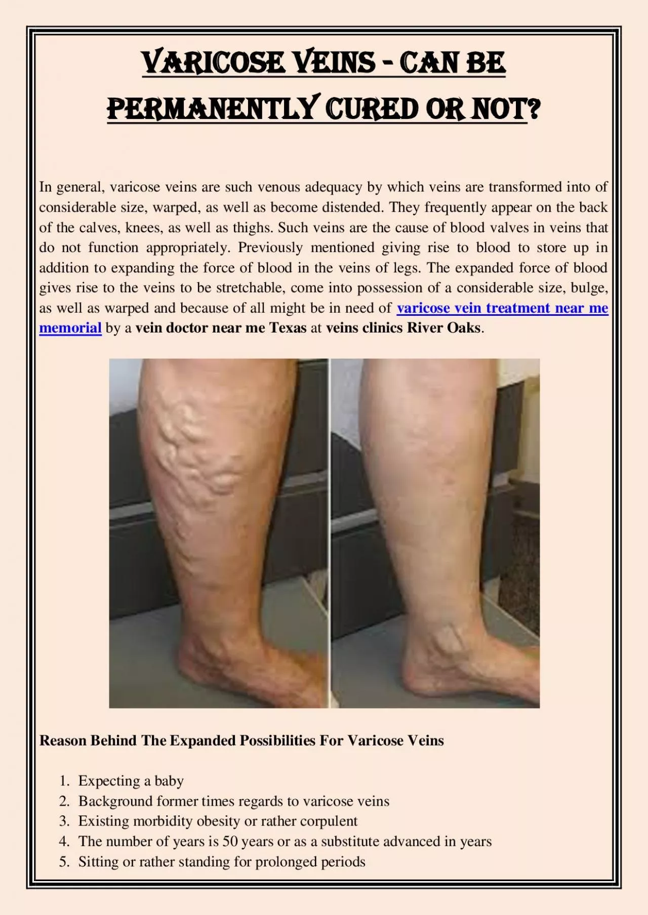 PDF-Varicose Veins - Can Be Permanently Cured Or Not?