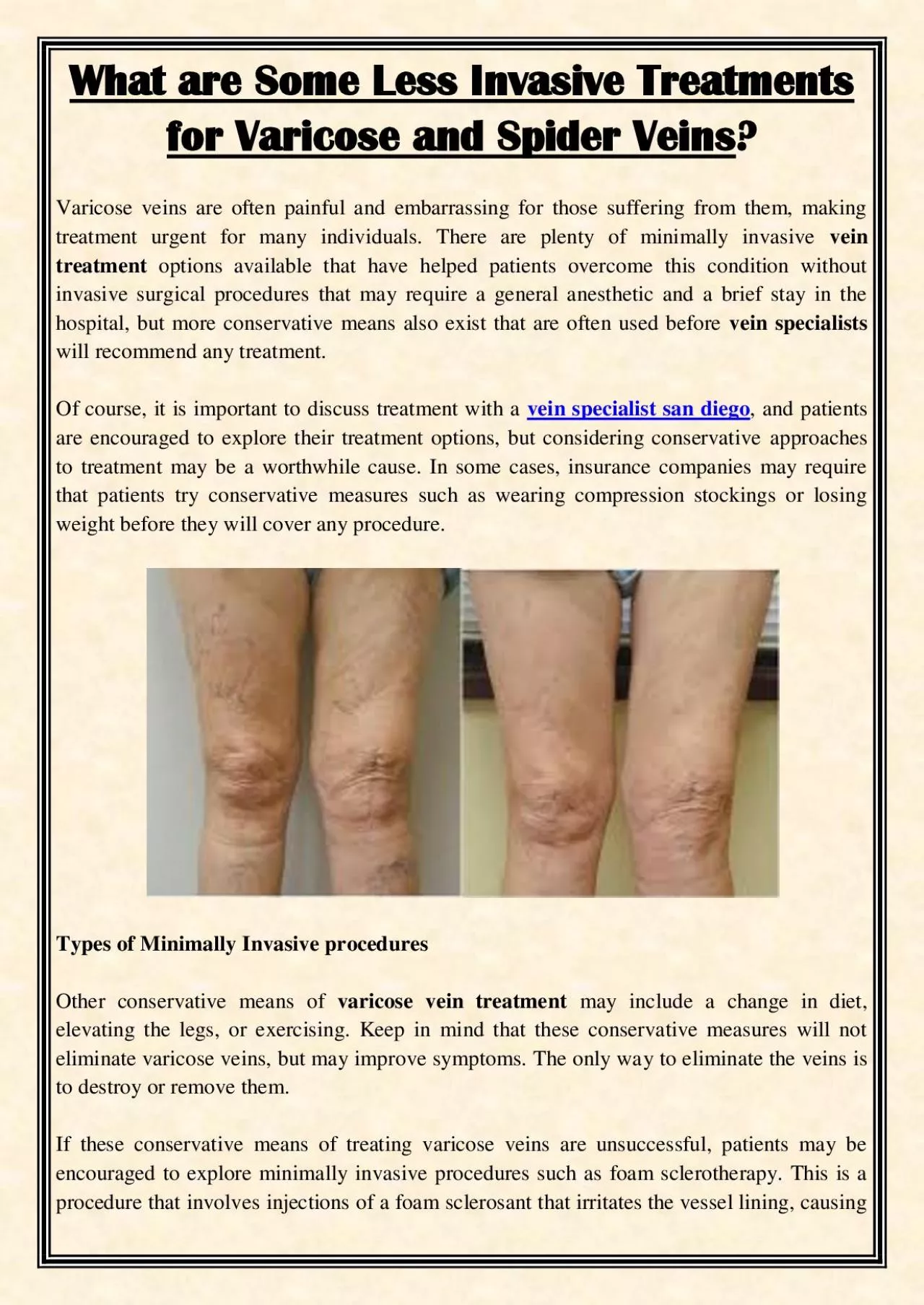 PDF-What are Some Less Invasive Treatments for Varicose and Spider Veins?