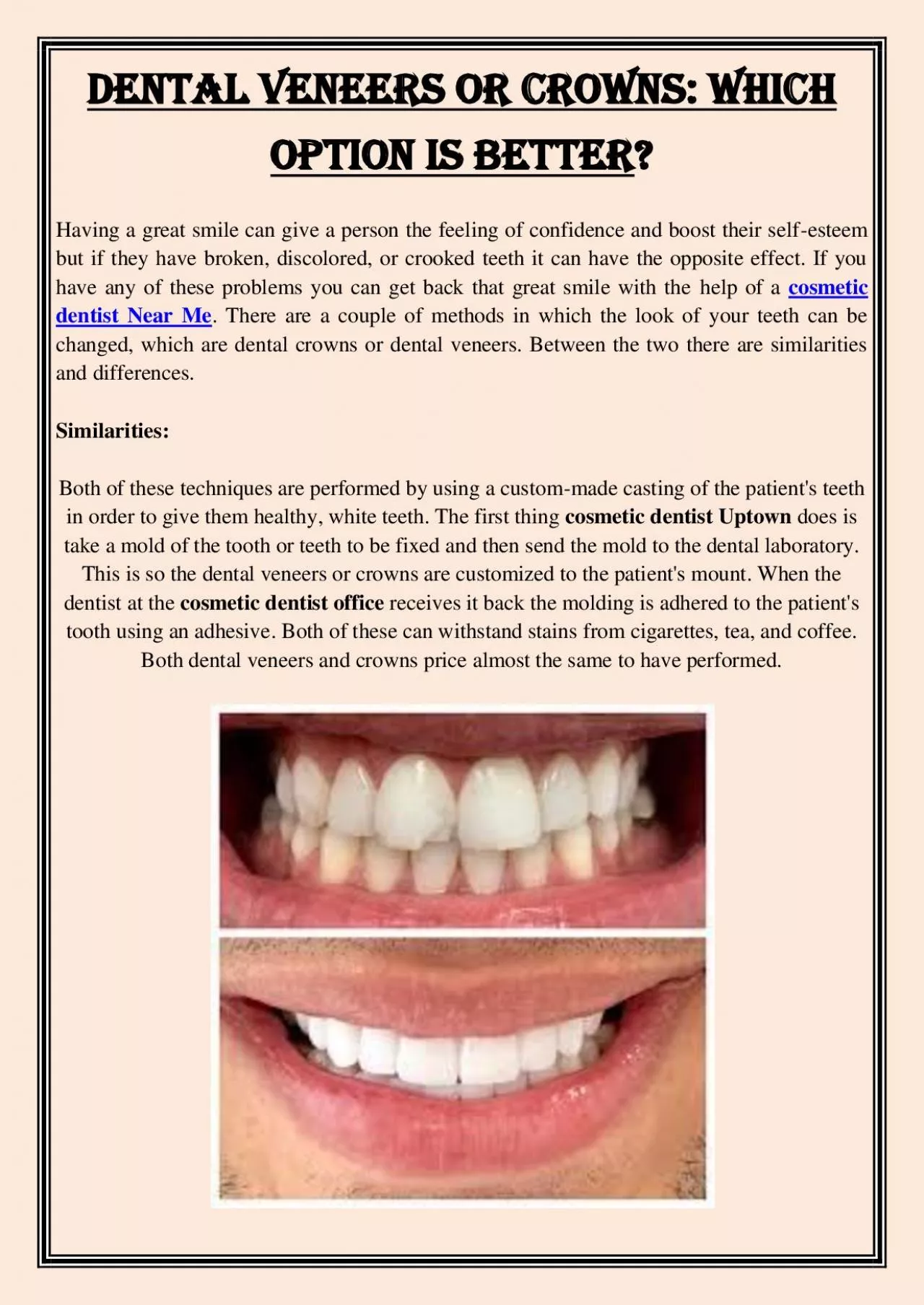 PDF-Dental Veneers or Crowns: Which Option Is Better?