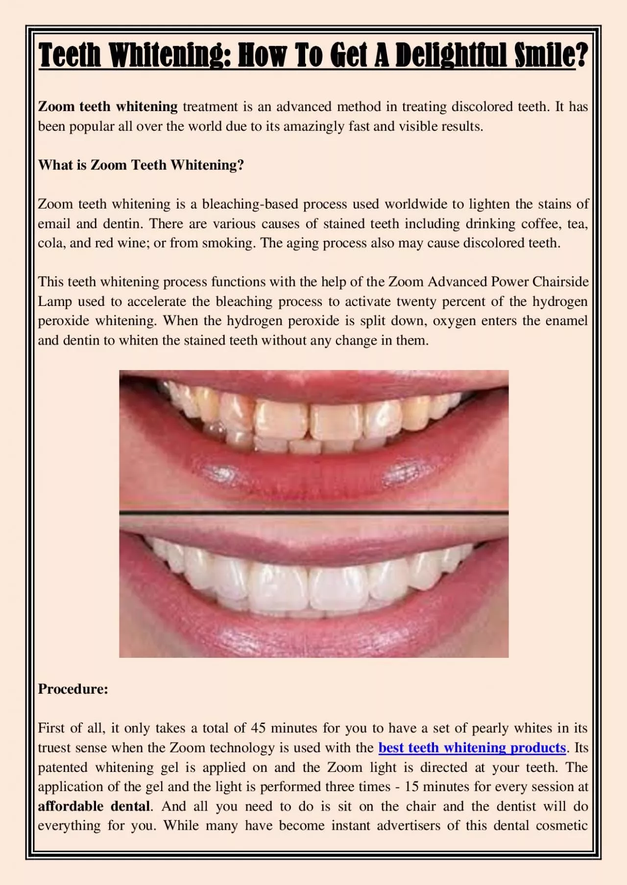 PDF-Teeth Whitening: How To Get A Delightful Smile?