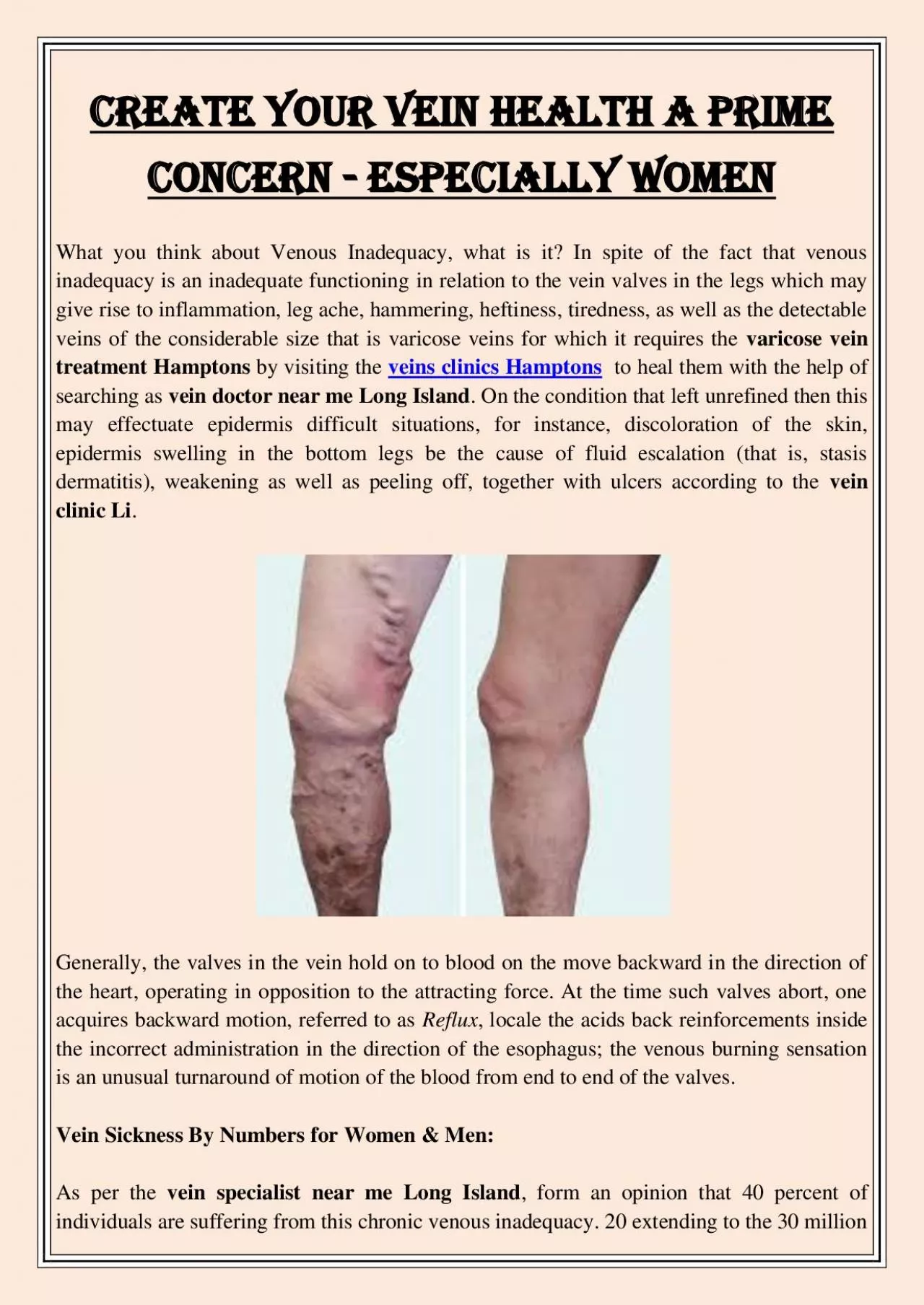 PDF-Create Your Vein Health A Prime Concern - Especially Women