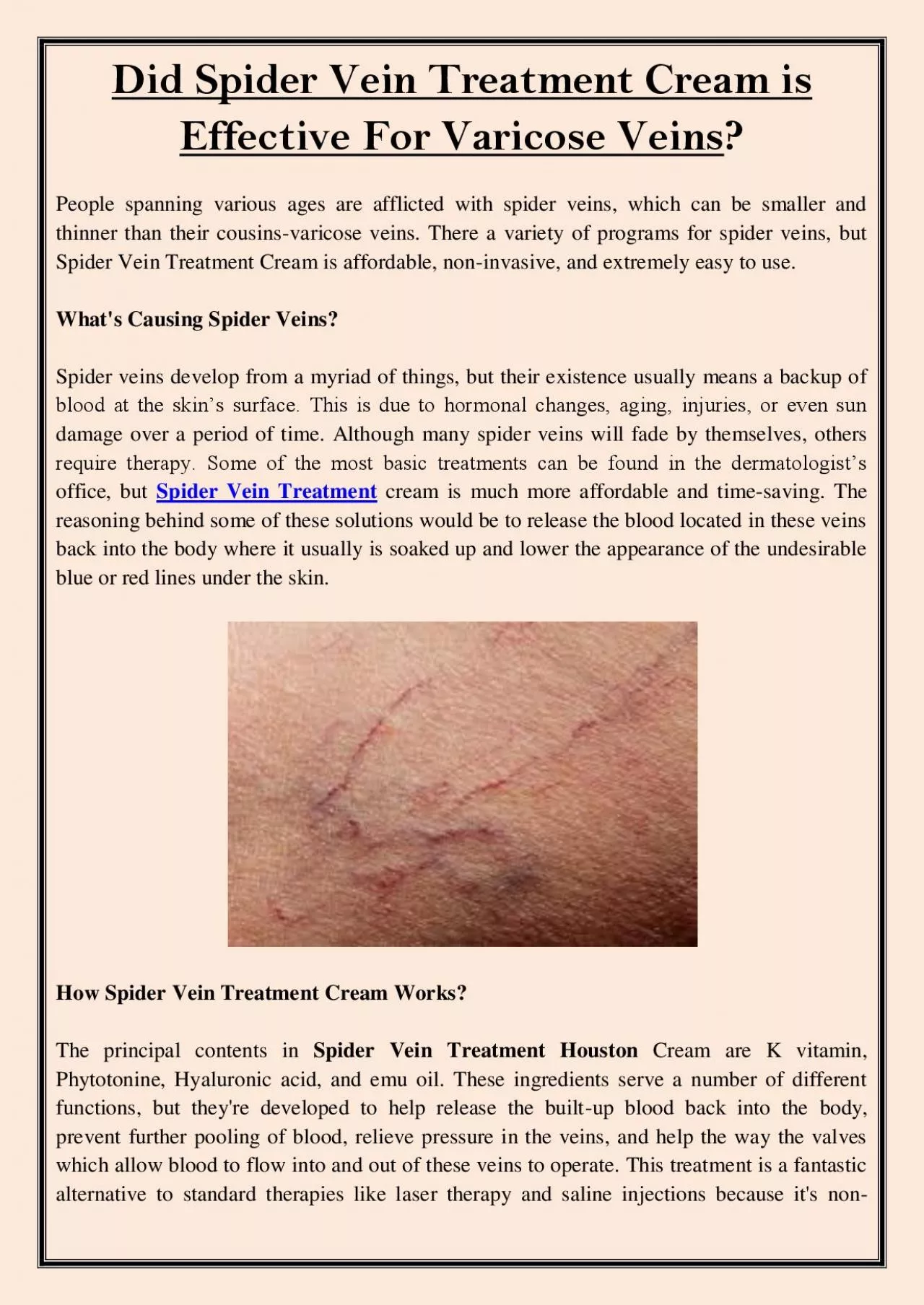 PDF-Did Spider Vein Treatment Cream is Effective For Varicose Veins?