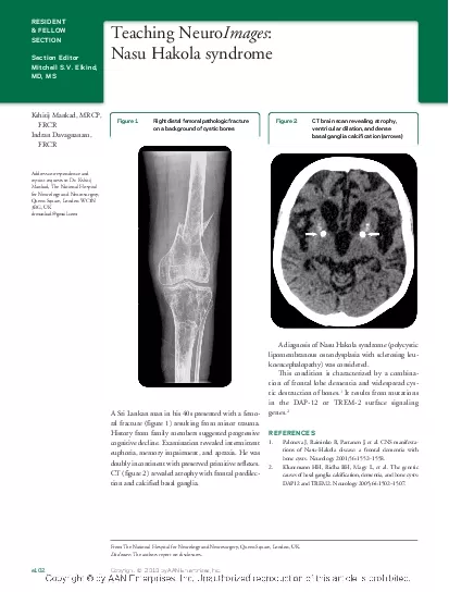 TeachingNeuroNasuHakolasyndromeKshitijMankadMRCPIndranDavagnanamASriLa