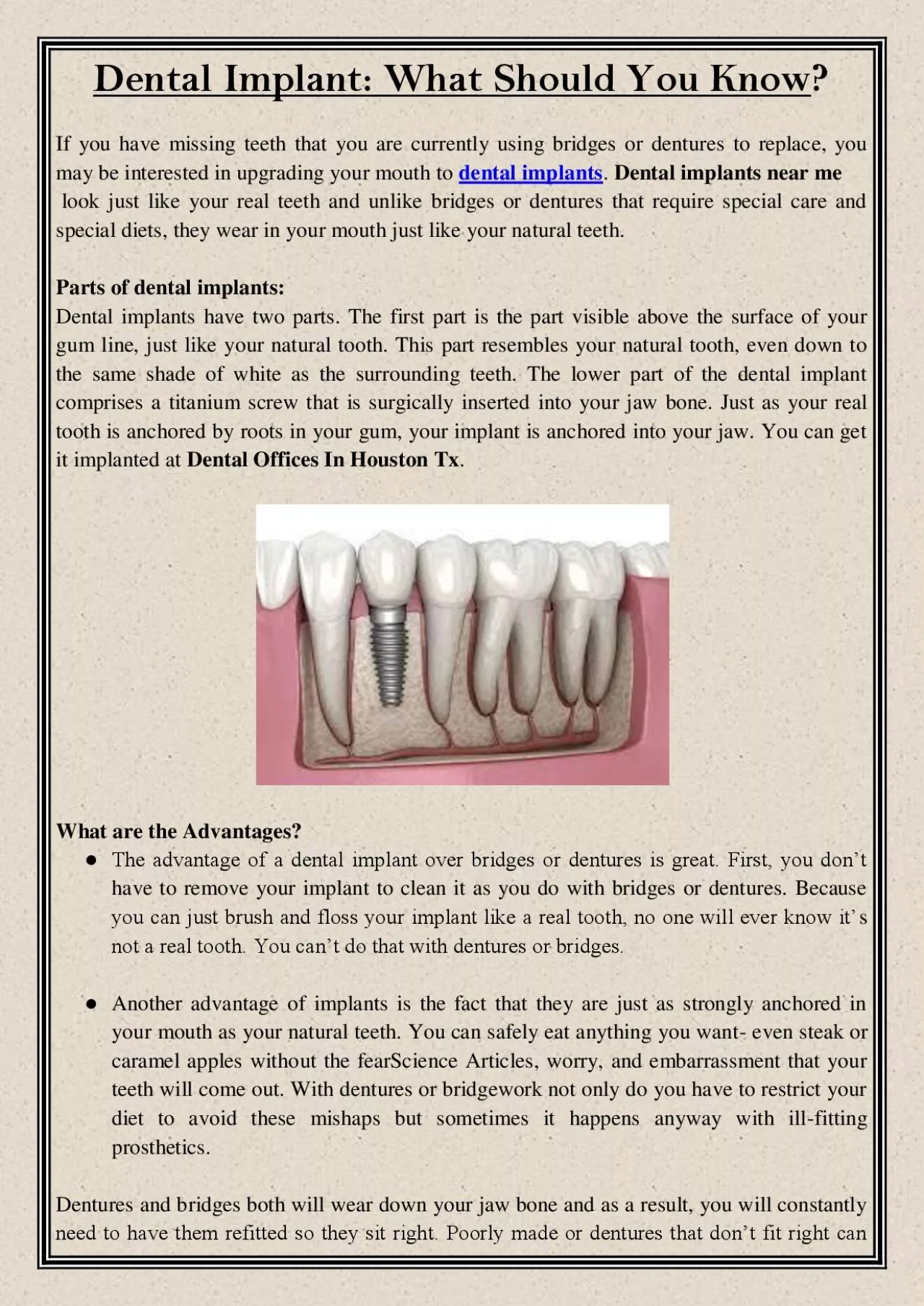 PDF-Dental Implant: What Should You Know?