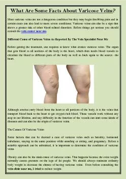 What Are Some Facts About Varicose Veins?