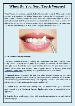 When Do You Need Teeth Veneers?