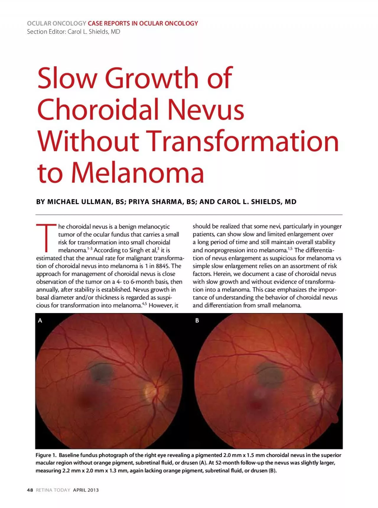 PDF-he choroidal nevus is a benign melanocytic tumor of the ocular fundus