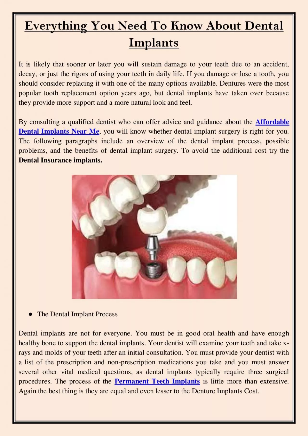 PDF-Everything You Need To Know About Dental Implants