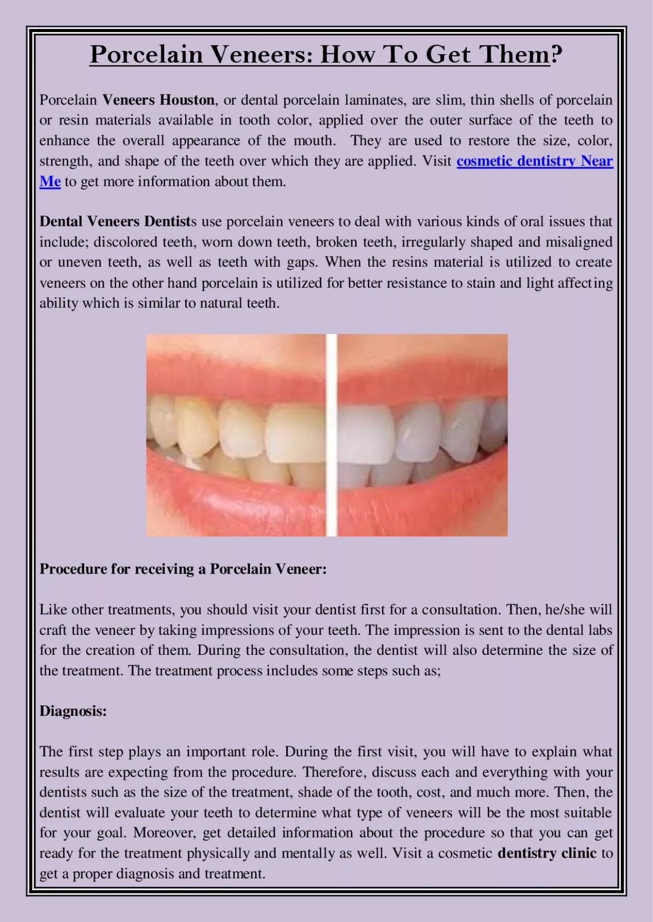 PDF-Porcelain Veneers: How To Get Them?