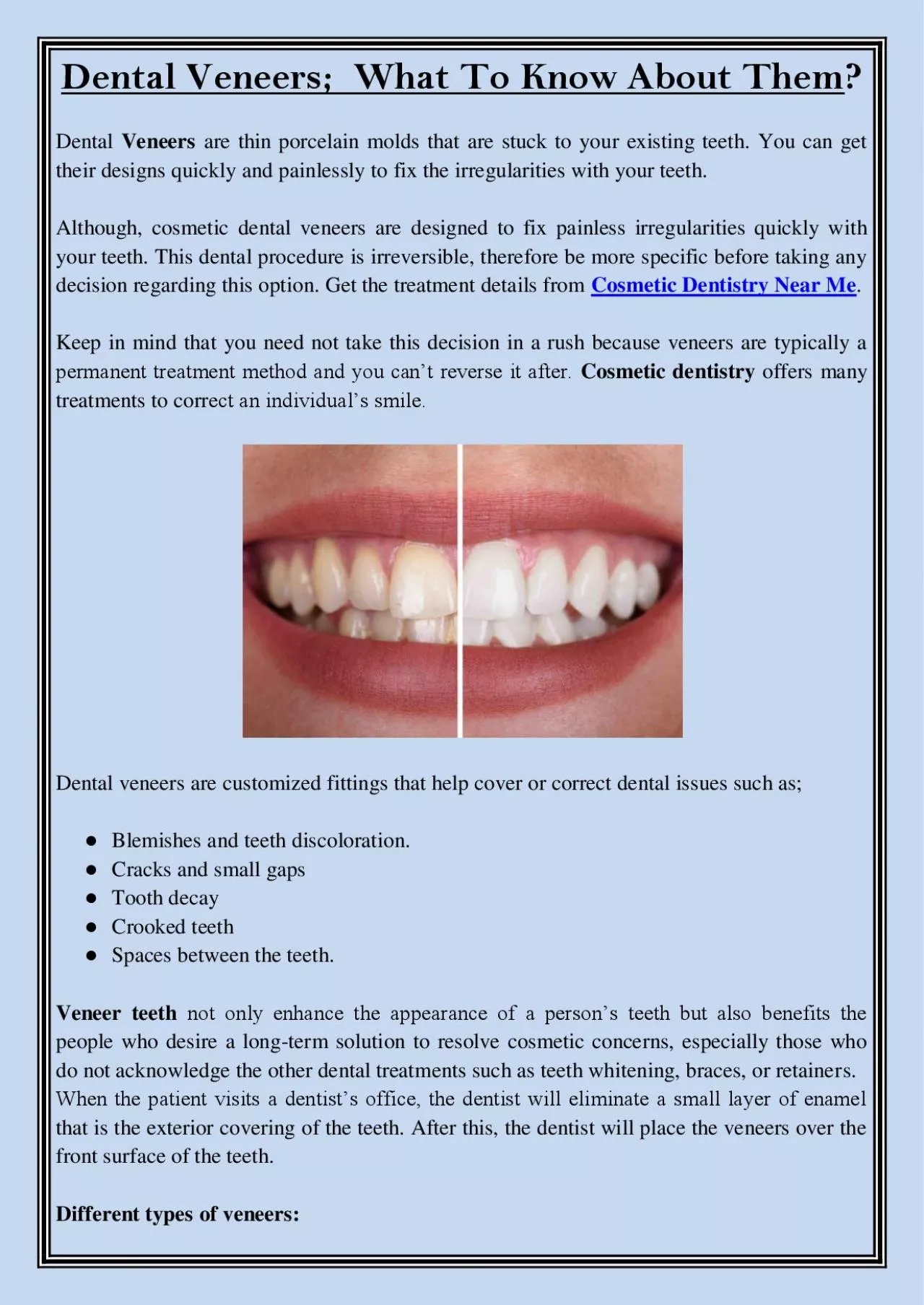 PDF-Dental Veneers; What To Know About Them?