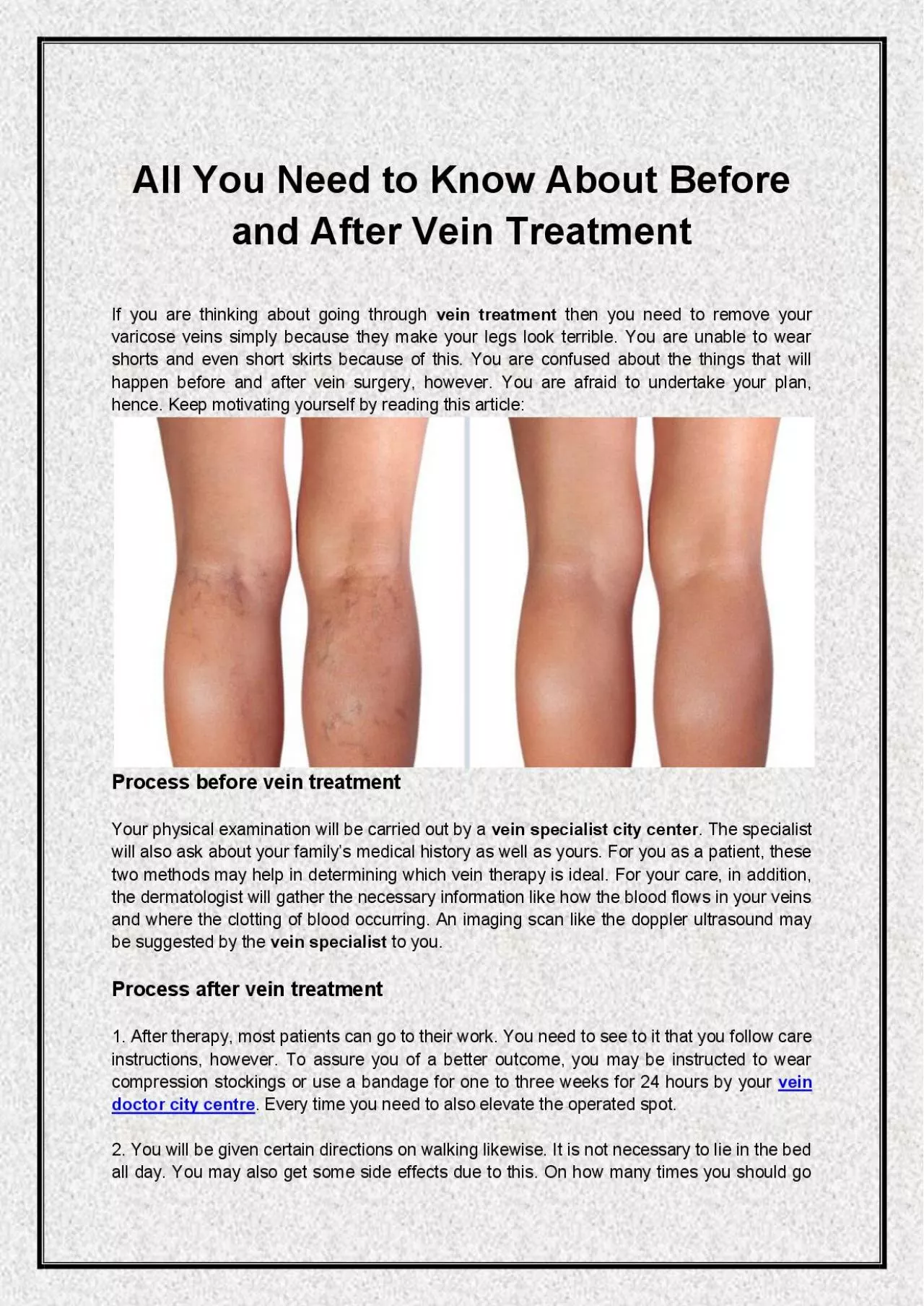 PDF-All You Need to Know About Before and After Vein Treatment