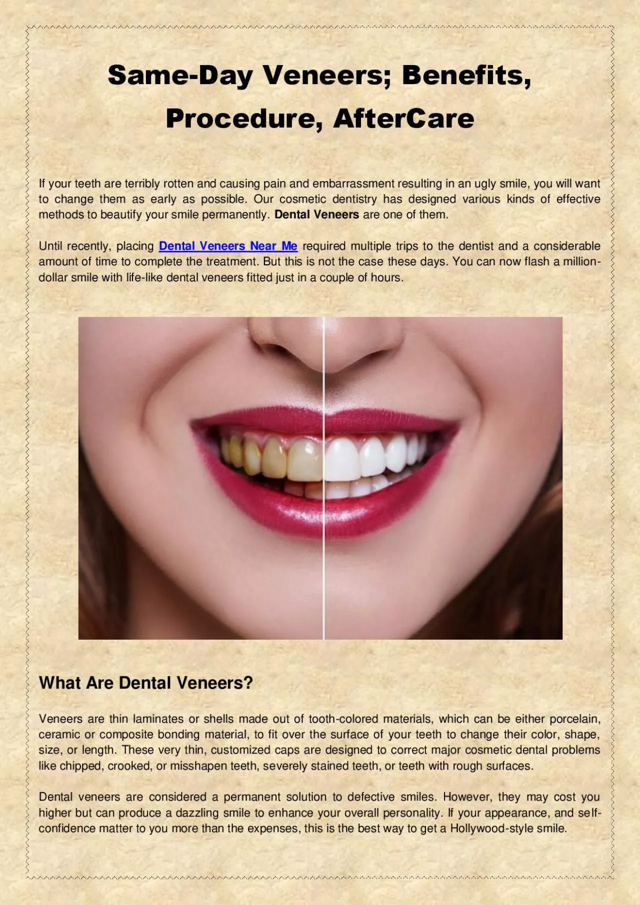 PDF-Same-Day Veneers; Benefits, Procedure, AfterCare