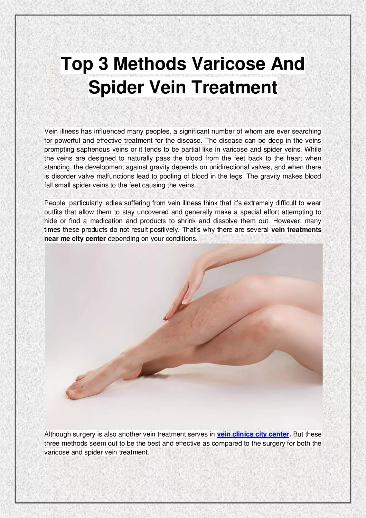 PDF-Top 3 Methods Varicose And Spider Vein Treatment