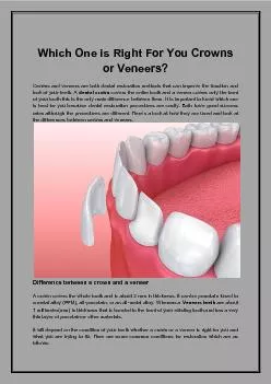 Which One is Right For You Crowns or Veneers?