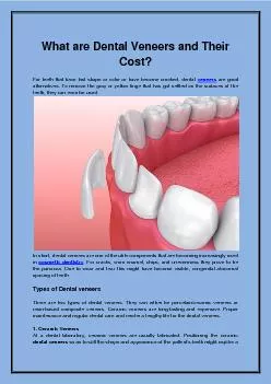 What are Dental Veneers and Their Cost?