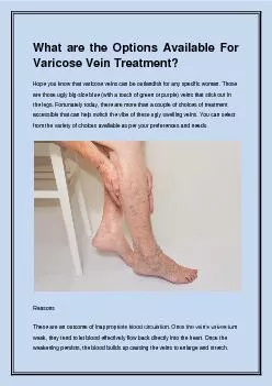 What are the Options Available For Varicose Vein Treatment?
