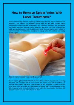 How to Remove Spider Veins With Laser Treatments?