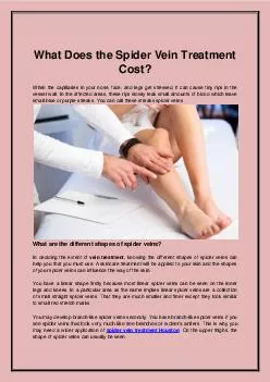What Does the Spider Vein Treatment Cost?