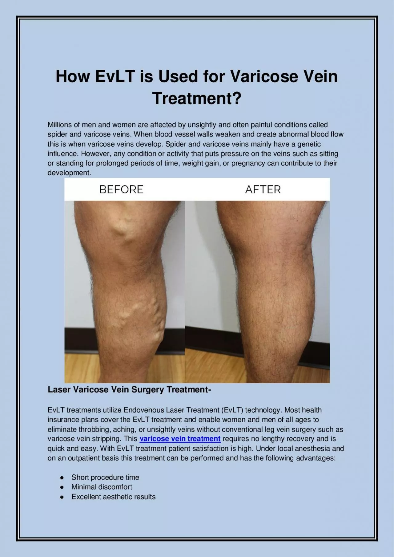 PDF-How EvLT is Used for Varicose Vein Treatment?