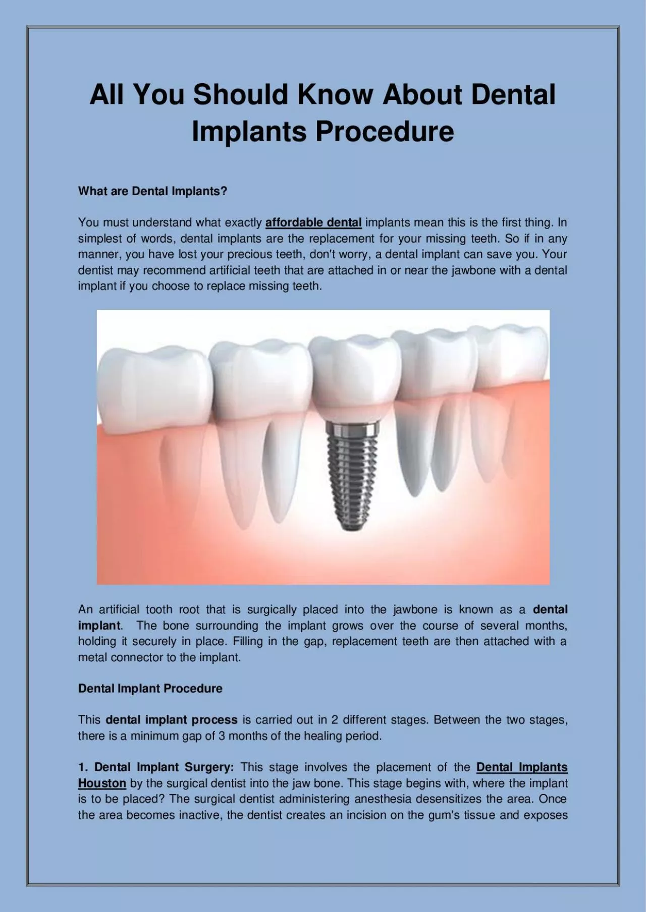 PDF-All You Should Know About Dental Implants Procedure