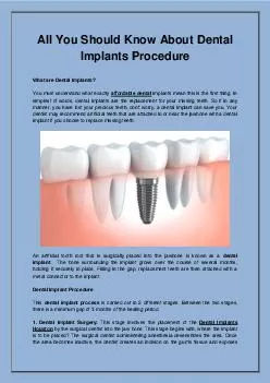 All You Should Know About Dental Implants Procedure