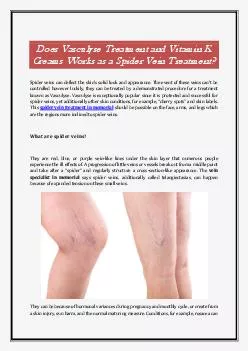 Does Vasculyse Treatment and Vitamin K Creams Works as a Spider Vein Treatment?