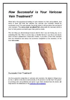 How Successful is Your Varicose Vein Treatment