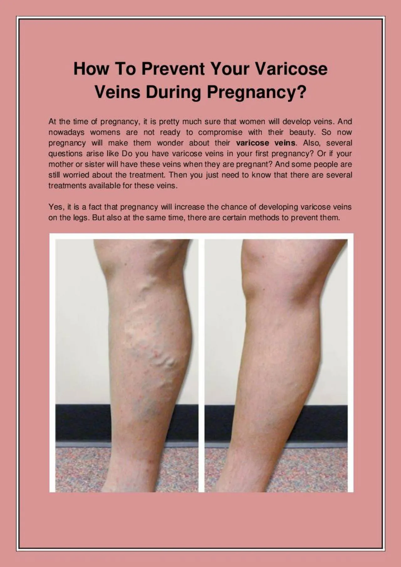 PDF-How To Prevent Your Varicose Veins During Pregnancy?