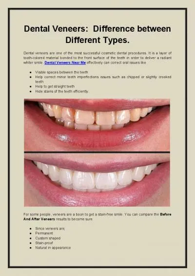 Dental Veneers Difference between Different Types