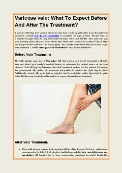 Varicose vein: What To Expect Before And After The Treatment?