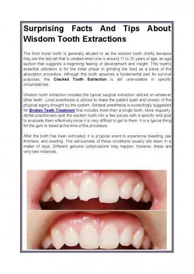 Surprising Facts And Tips About Wisdom Tooth Extractions