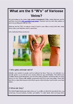 What are the 5 “W’s” of Varicose Veins