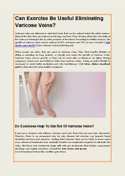 Can Exercise Be Useful Eliminating Varicose Veins