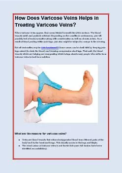 How Does Varicose Veins Helps in Treating Varicose Veins