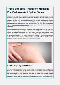 Three Effective Treatment Methods For Varicose And Spider Veins: