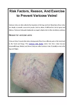 Risk Factors, Reason, And Exercise to Prevent Varicose Veins!