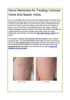 Home Remedies for Treating Varicose Veins And Spider Veins