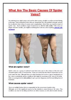 What Are The Basic Causes Of Spider Veins?