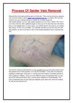 Process Of Spider Vein Removal