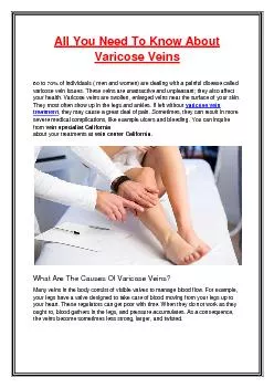 All You Need To Know About Varicose Veins