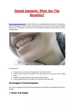 Dental Implants: What Are The Benefits?