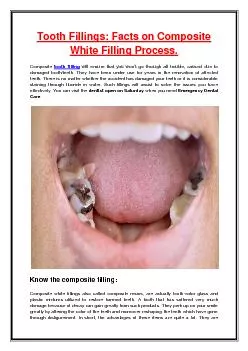 Tooth Fillings: Facts on Composite White Filling Process.