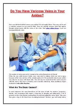 Do You Have Varicose Veins in Your Ankles?