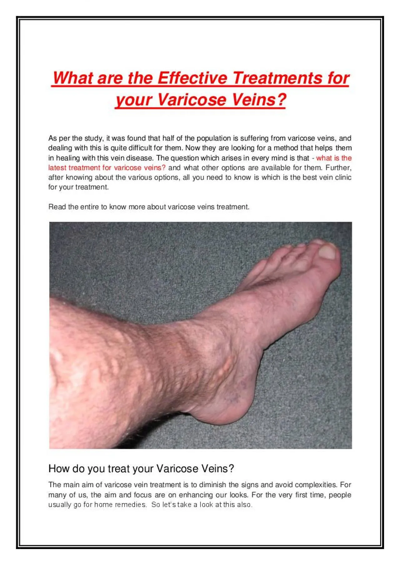 PDF-What are the Effective Treatments for your Varicose Veins?