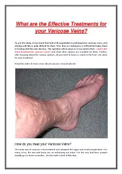 What are the Effective Treatments for your Varicose Veins?