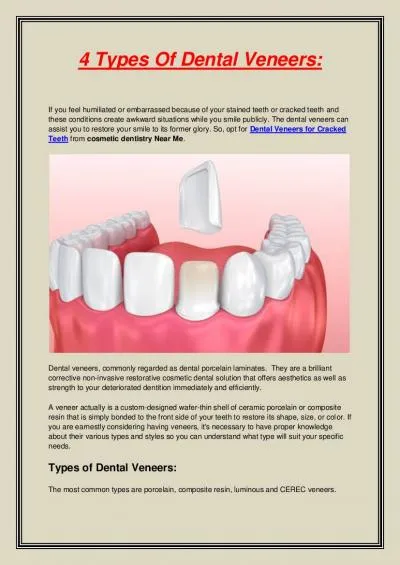 4 Types Of Dental Veneers